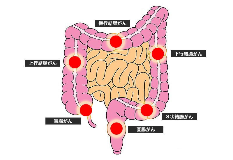 大腸 押す と 痛い